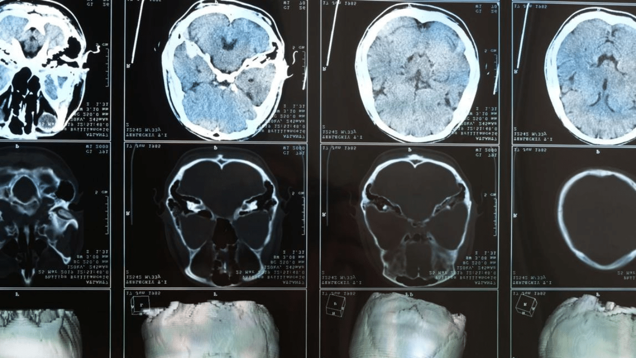 A series of brain and skull CT scan images showing axial and coronal views with different cross-sectional slices.