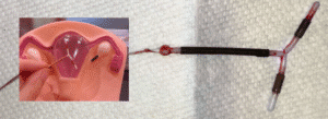 Photograph of a copper IUD with some blood on it; inset shows a hand demonstrating IUD placement in a uterine model.