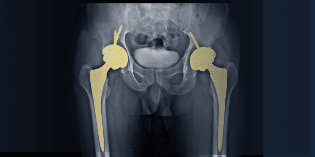 X-ray image of a pelvis showing bilateral hip replacements with prosthetic implants in both hip joints.