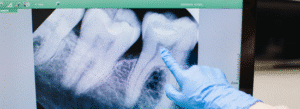A gloved hand points to a dental X-ray on a screen, highlighting details of molar teeth and roots.