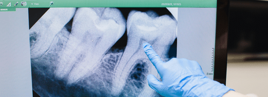 A gloved hand points to a dental X-ray on a screen, highlighting details of molar teeth and roots.