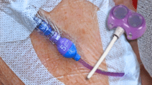 A close-up of a medical IV line inserted into skin, secured with adhesive bandages; a purple, toy-like object with a stick is digitally added to the right.