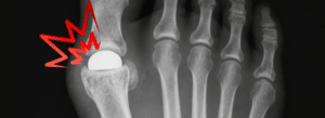 X-ray of a foot showing a red pain symbol at the big toe joint, indicating possible injury or inflammation.