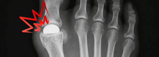 X-ray of a foot showing a red pain symbol at the big toe joint, indicating possible injury or inflammation.
