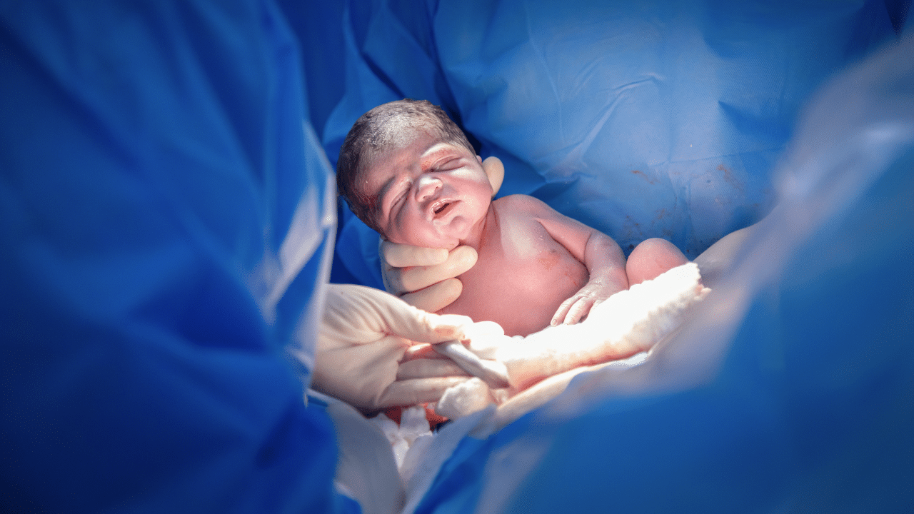 A newborn baby is held by a gloved hand during delivery, surrounded by blue surgical drapes.