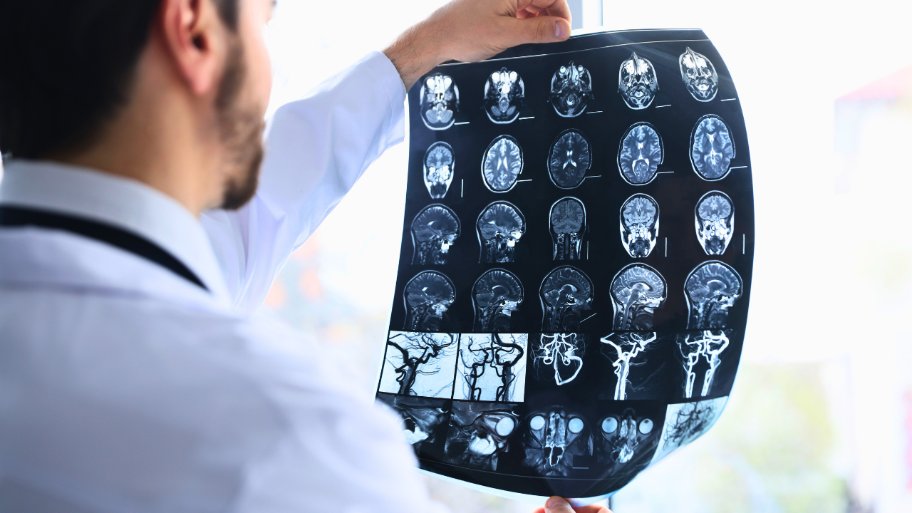 Understanding the Role of a Brain Injury Lawyer in New York State