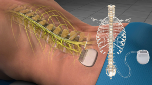 An illustration of a spinal cord stimulator implant, showing the device connected to leads placed along the spine, with a separate view of the skeleton and device.