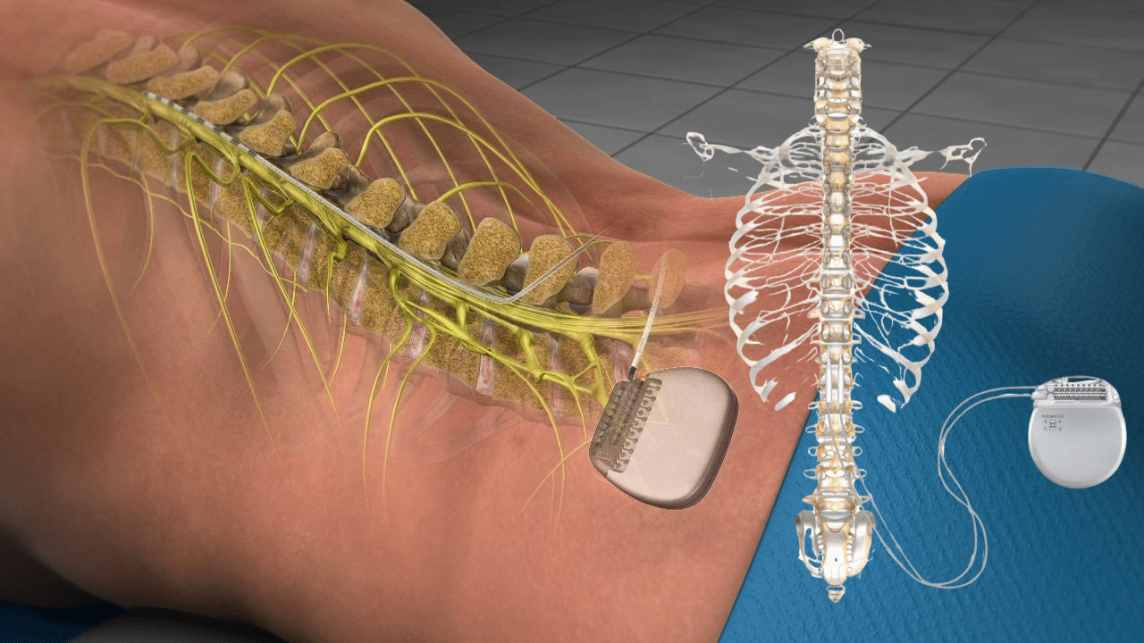 An illustration of a spinal cord stimulator implant, showing the device connected to leads placed along the spine, with a separate view of the skeleton and device.